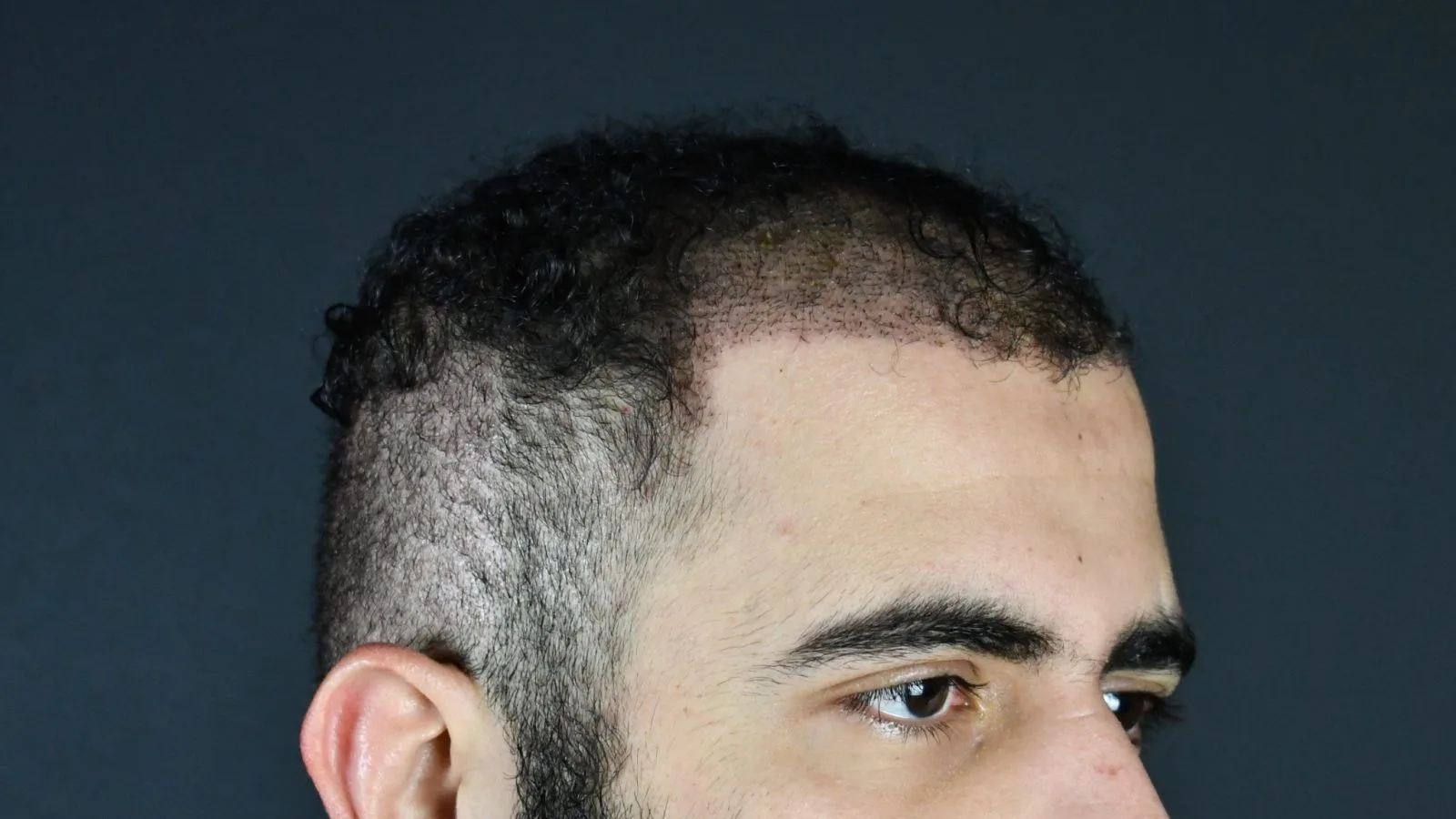 Male patient's head in profile showing hair loss pattern and receding hairline